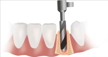 XENJA EMMYLOU WALENDY ZAHNÄRZTIN | FACHZAHNÄRZTIN FÜR ORALCHIRURGIE - Implantate