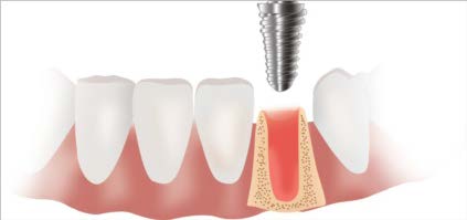 XENJA EMMYLOU WALENDY ZAHNÄRZTIN | FACHZAHNÄRZTIN FÜR ORALCHIRURGIE - Implantate