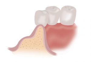 XENJA EMMYLOU WALENDY ZAHNÄRZTIN | FACHZAHNÄRZTIN FÜR ORALCHIRURGIE - Knochenblock OP