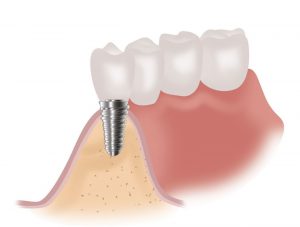 XENJA EMMYLOU WALENDY ZAHNÄRZTIN | FACHZAHNÄRZTIN FÜR ORALCHIRURGIE - Knochenblock OP