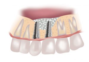 XENJA EMMYLOU WALENDY ZAHNÄRZTIN | FACHZAHNÄRZTIN FÜR ORALCHIRURGIE - Sinuslift