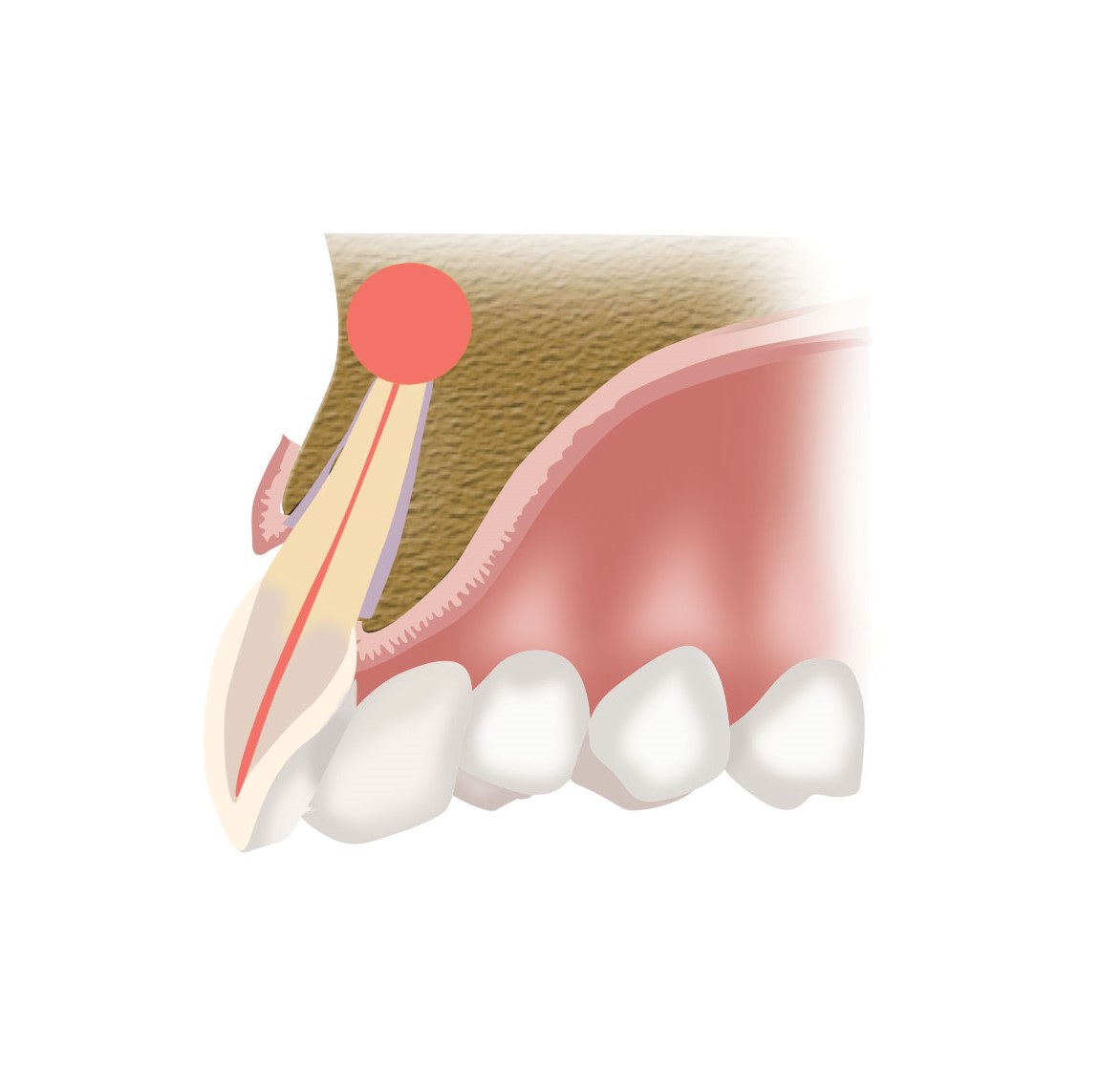 XENJA EMMYLOU WALENDY ZAHNÄRZTIN | FACHZAHNÄRZTIN FÜR ORALCHIRURGIE - Wurzelspitzenresektion