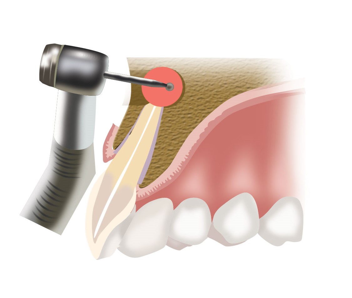 XENJA EMMYLOU WALENDY ZAHNÄRZTIN | FACHZAHNÄRZTIN FÜR ORALCHIRURGIE - Wurzelspitzenresektion